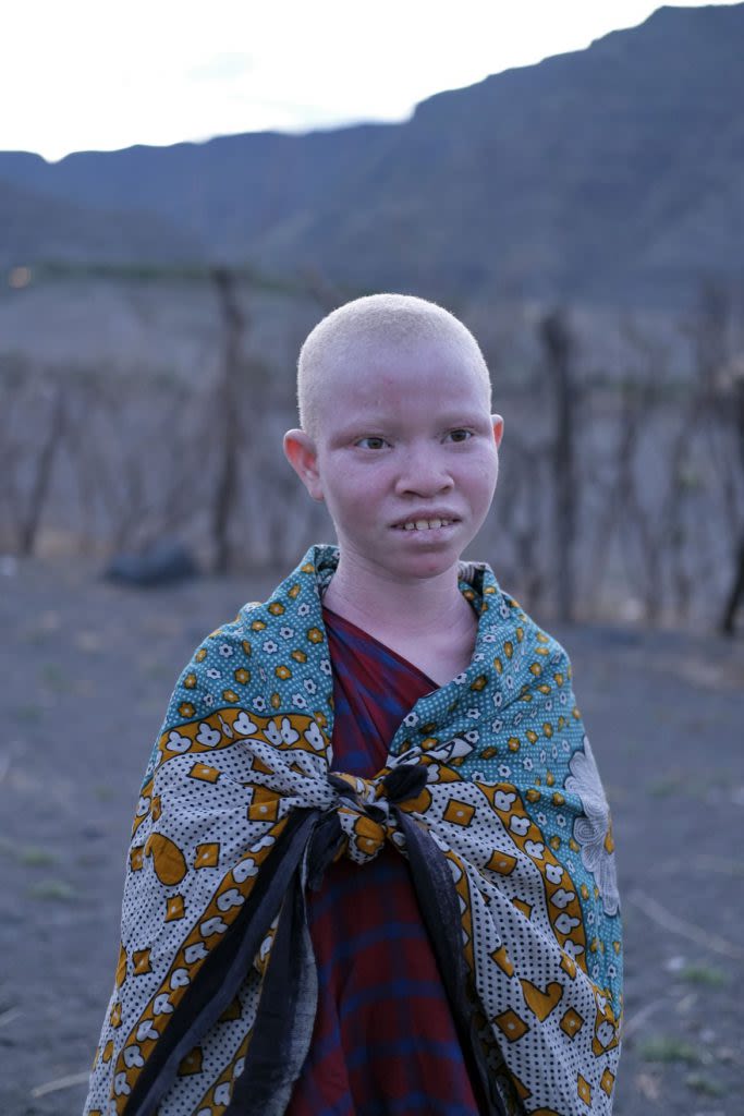 Albino Maasai boy with a colourful wrap around his shoulders