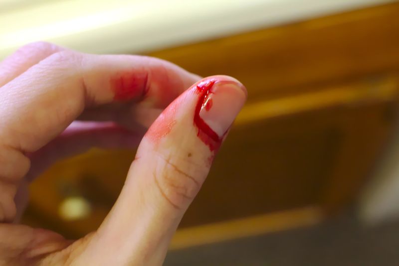 Close up of a woman's bleeding thumb, blood injury